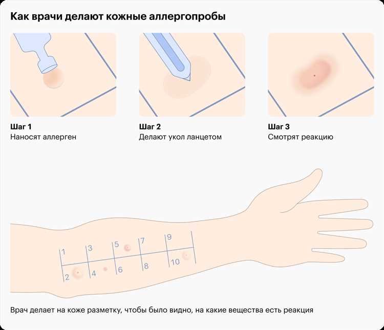 Как предотвратить аллергию на продукты у ребенка