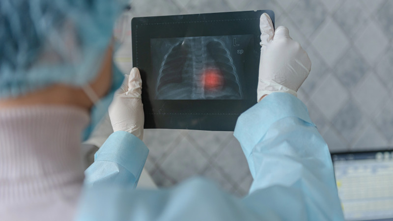 Туберкулёз выявлен у студентов вузов Казахстана: Минздрав подтверждает серьезность ситуации