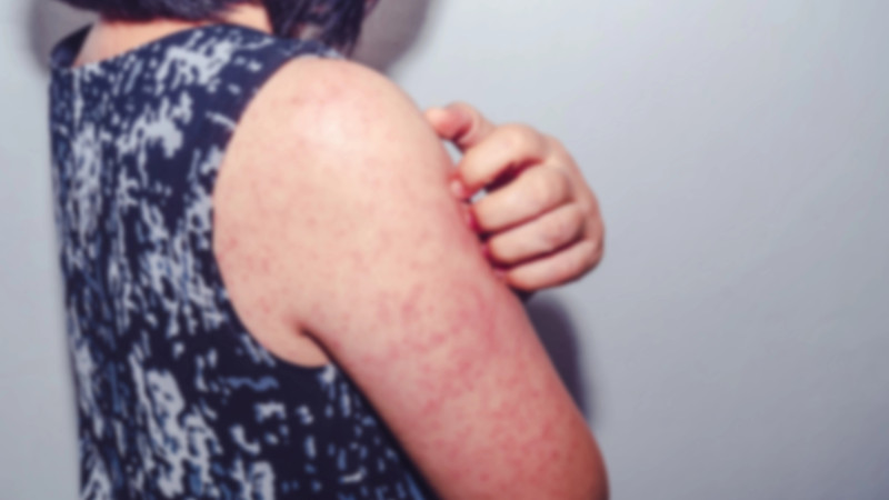 В Казахстане вновь выросла заболеваемость корью среди непривитых детей