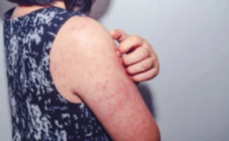 В Казахстане вновь выросла заболеваемость корью среди непривитых детей