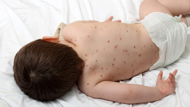 Корь вновь угрожает Казахстану: вспышки поднимают тревогу