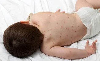 Корь вновь угрожает Казахстану: вспышки поднимают тревогу