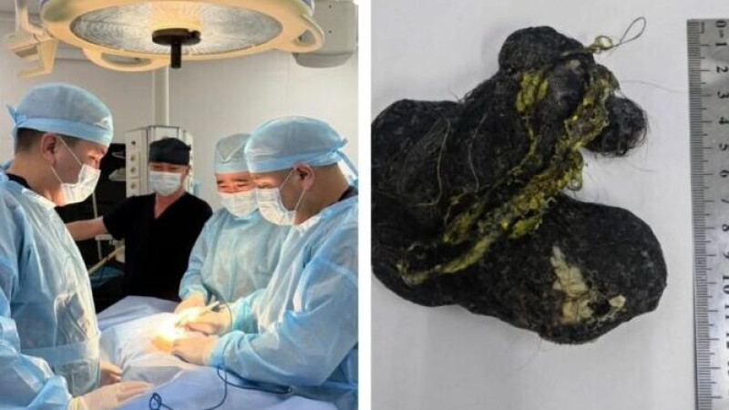 В Шымкенте хирурги удалили 15 см ком волос из желудка ребенка