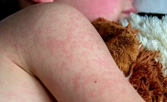 Корь в Алматы: ситуация напряжённая, новые случаи по Казахстану